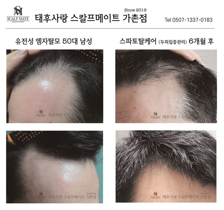 엠자탈모 50대 남성고객 (두피집중관리 6개월 경과) 1