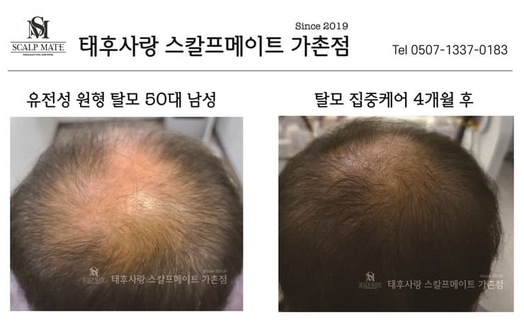 남성정수리 탈모 집중관리효과 3