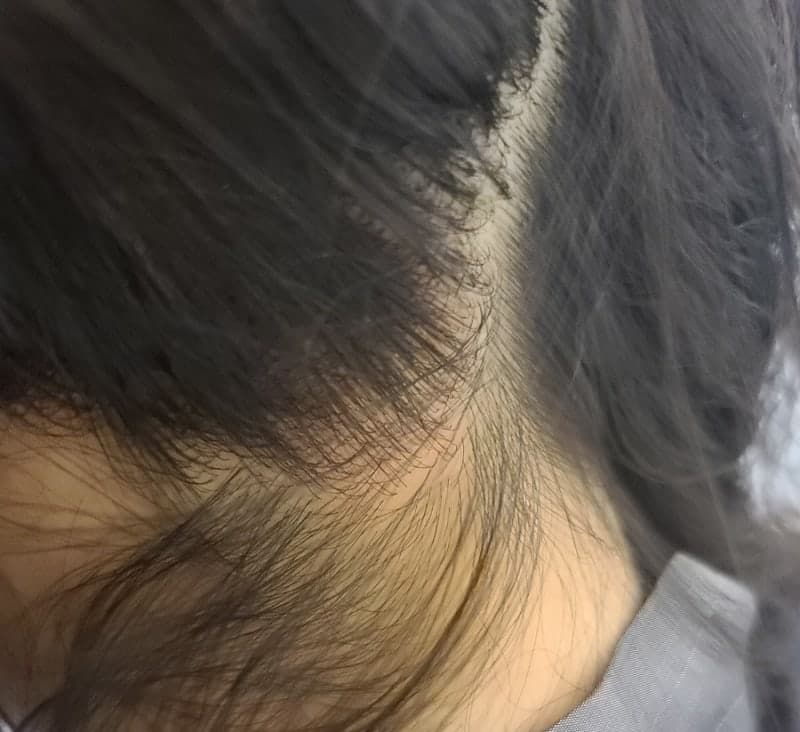 건선두피관리효과 3
