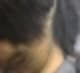 건선두피관리효과 4